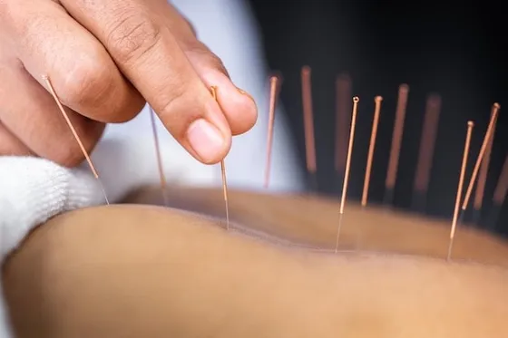 Chinese Traditional Acupuncture for Wellness