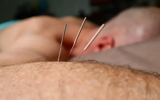 Acupuncture for Depression and Bipolar Disorder