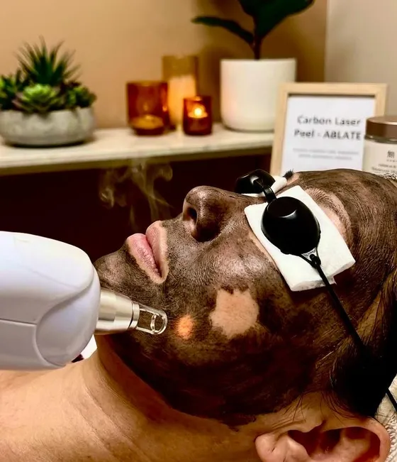 OJAS Pure — Carbon Laser Peel
