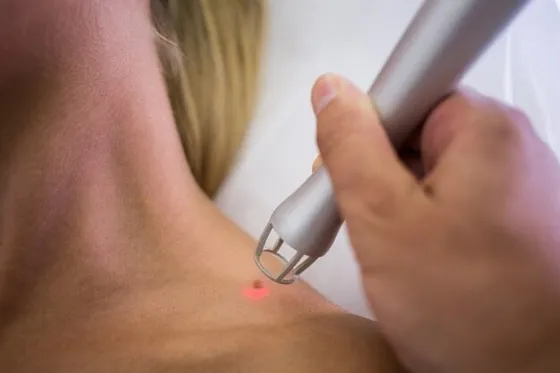Freckles Removal / Fading